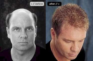hair photo:hair loss is 