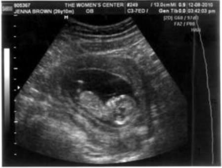 12 5 week ultrasound. 12 5 week ultrasound.